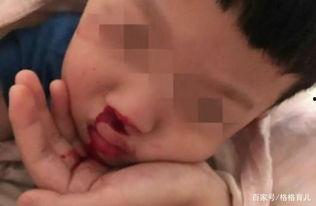 情侣白天流鼻血在线视频,揭秘浪漫背后的健康秘密